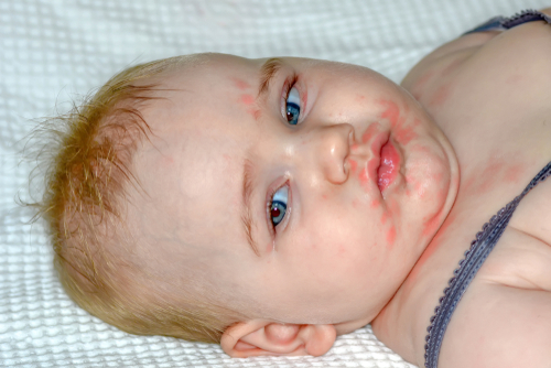 אודם בפנים אצל ילדים עם דלקת עור אטופית